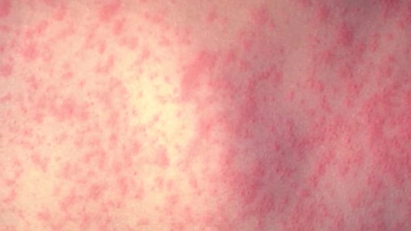 Canada's falling vaccination rates set the stage for measles cases to grow into a massive,...