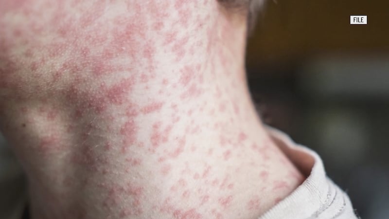 Health officials have announced that measles is no longer in Bangor wastewater after a sample...
