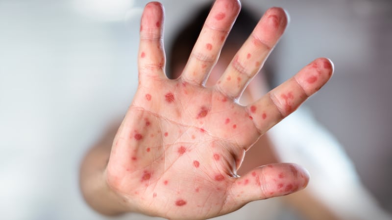 Measles